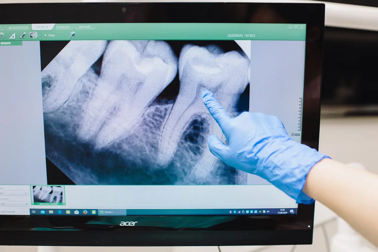 Are Dental X-Rays Safe?